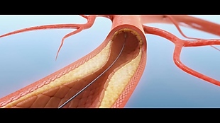 血小板血管医学视频