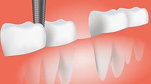 牙齿手术视频素材